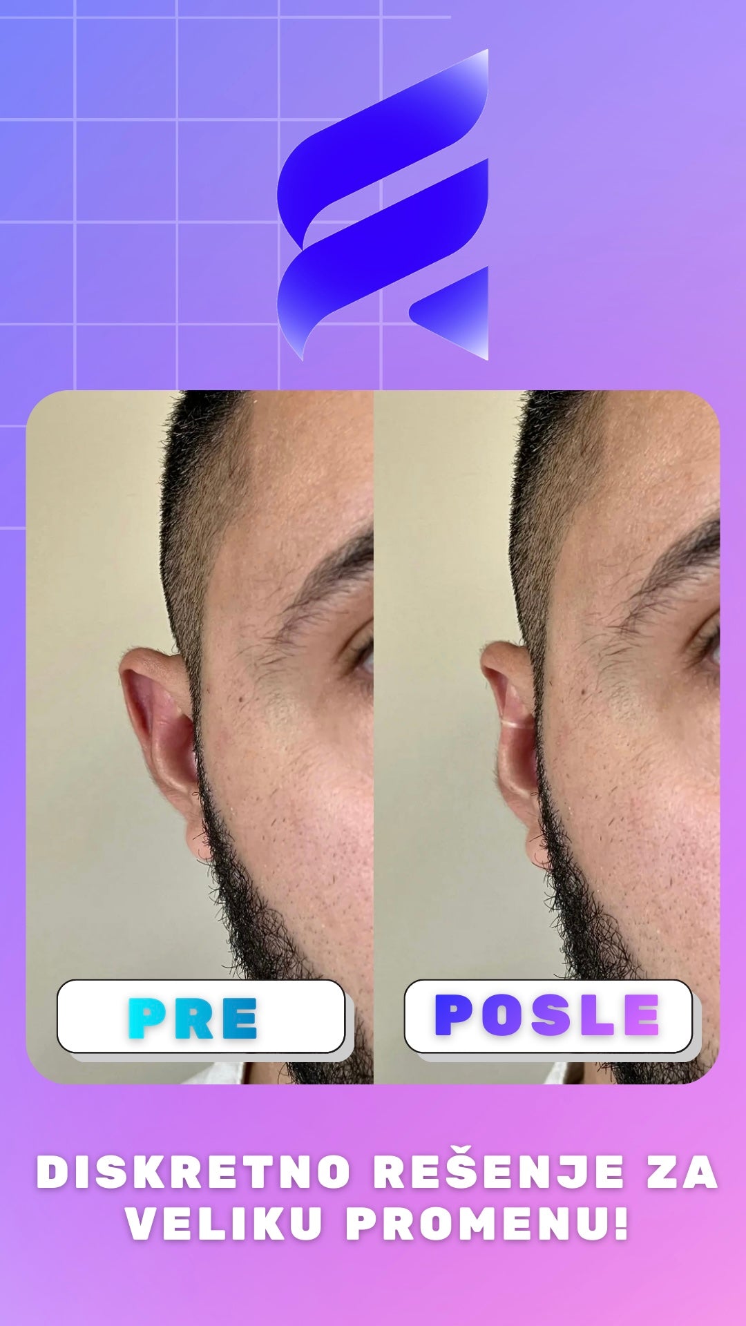 Fix Clip – korektor za klempave uši